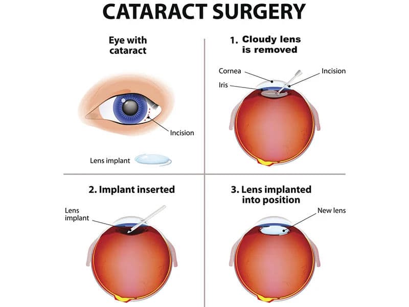 Cataract surgery at iSight Eye Care Mumbai – no patch, no stitch